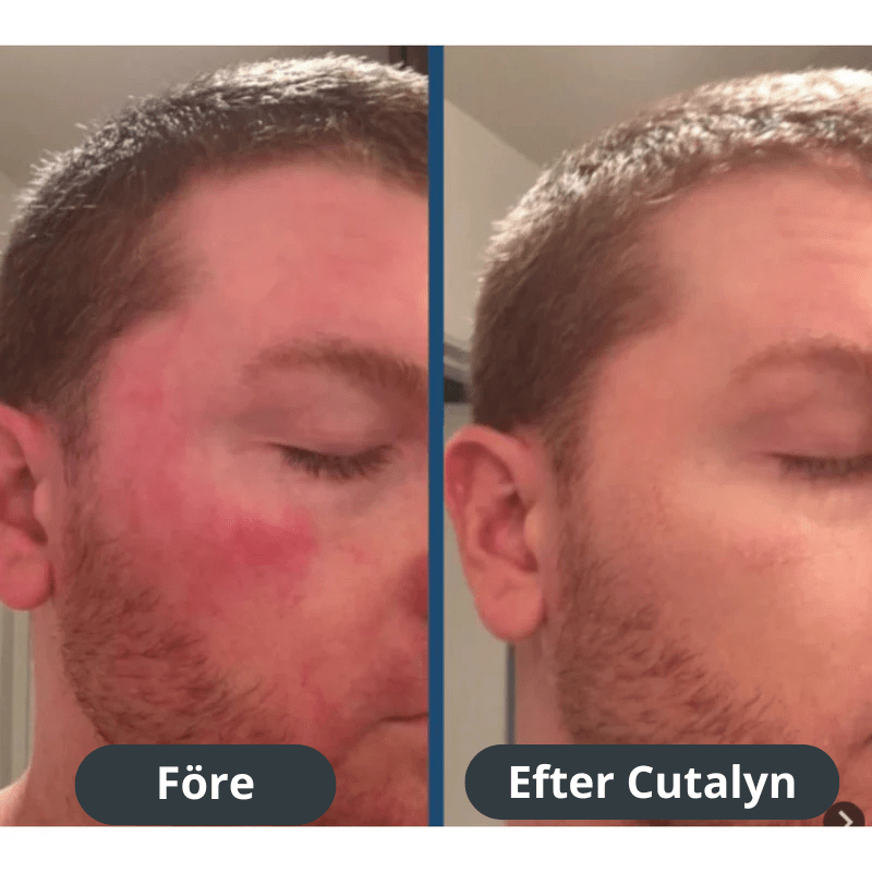 Cutalyn® Duo+ ⎜ Målriktad lindring för skägg och hårbotten