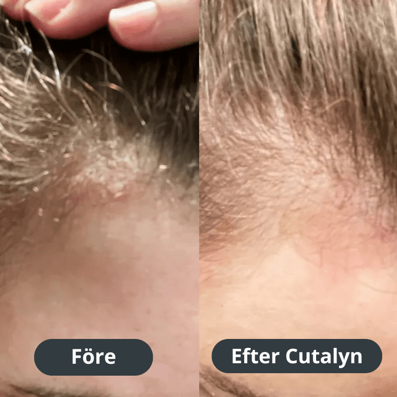 Cutalyn® Duo+ ⎜ Målriktad lindring för skägg och hårbotten