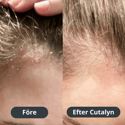 Cutalyn® Duo+ ⎜ Målriktad lindring för skägg och hårbotten