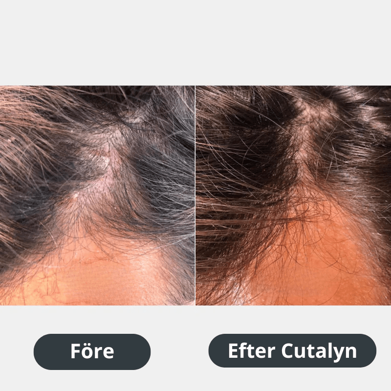 Cutalyn® Duo+ ⎜ Målriktad lindring för skägg och hårbotten