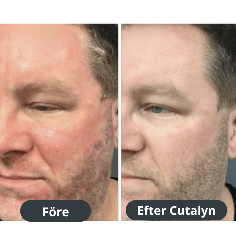 Cutalyn® Duo+ ⎜ Målriktad lindring för skägg och hårbotten