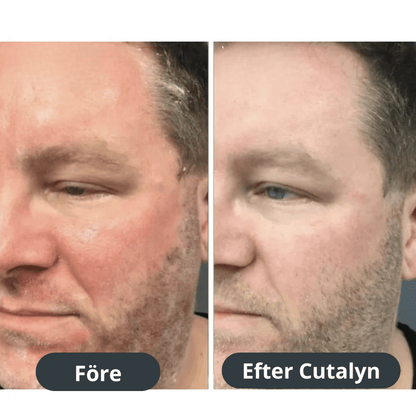 Cutalyn® Duo+ ⎜ Målriktad lindring för skägg och hårbotten