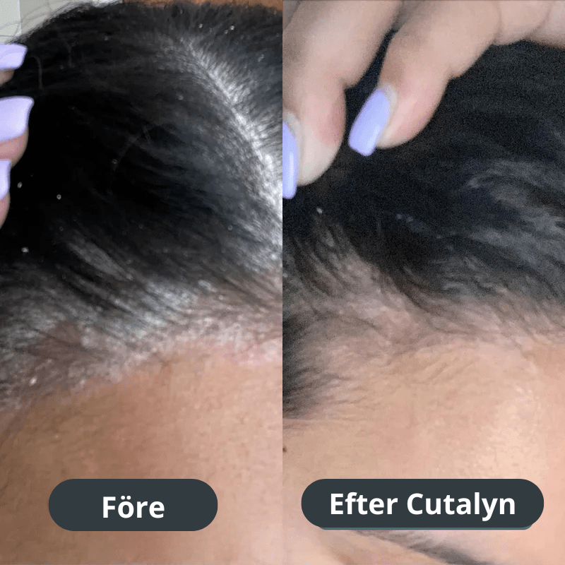 Cutalyn® Duo+ ⎜ Målriktad lindring för skägg och hårbotten